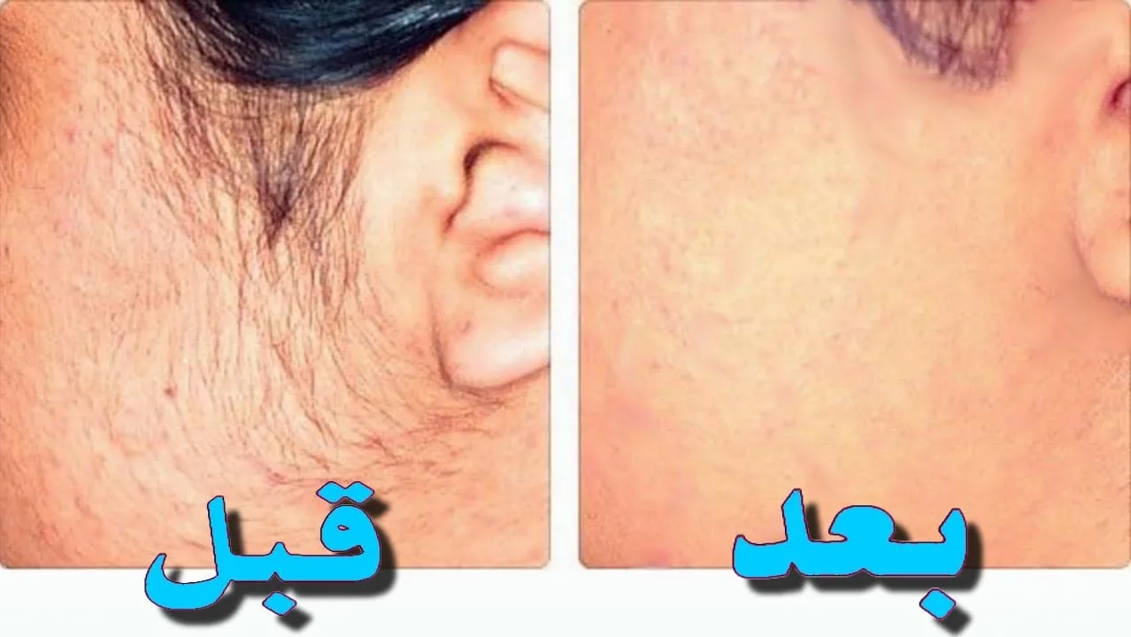 زيلي كل الشعر الزائد.. طريقة يابانية لإزالة الشعر الزائد نهائيا بدون ألم ومن الجذور وتبيض فوري للمناطق الغامقة